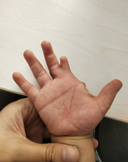 幼童手指多指并指畸形 医生妙手矫正